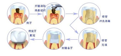 根管治疗过程图 根管治疗过程图