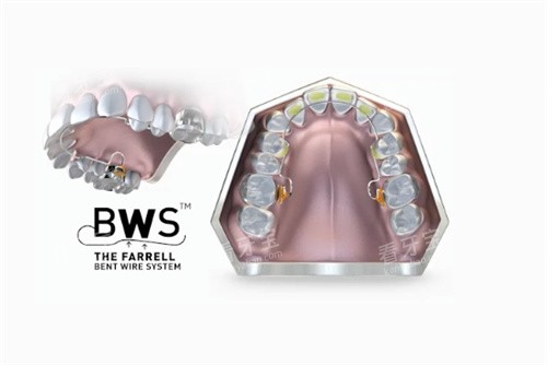 Myobrace