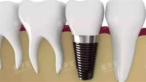 种植牙后效果图 种植牙后效果图