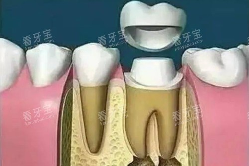 根管治疗戴牙冠卡通图 根管治疗戴牙冠卡通图