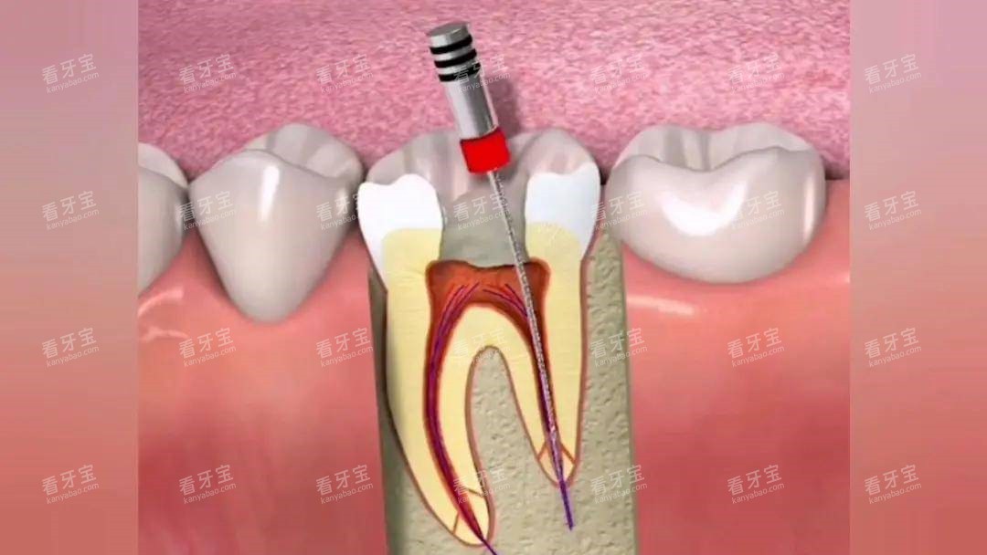根管治疗的过程示意图 根管治疗的过程示意图