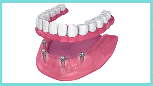 半口种植牙动画展示图 半口种植牙动画展示图