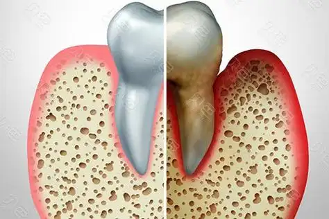 正常牙槽骨&被吸收的牙槽骨 正常牙槽骨&被吸收的牙槽骨