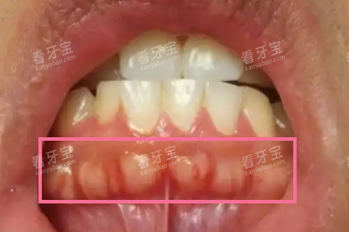 牙槽骨增生.webp 牙槽骨增生.webp