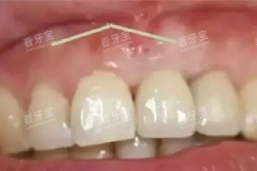 牙槽骨增生口内实拍图.webp 牙槽骨增生口内实拍图.webp