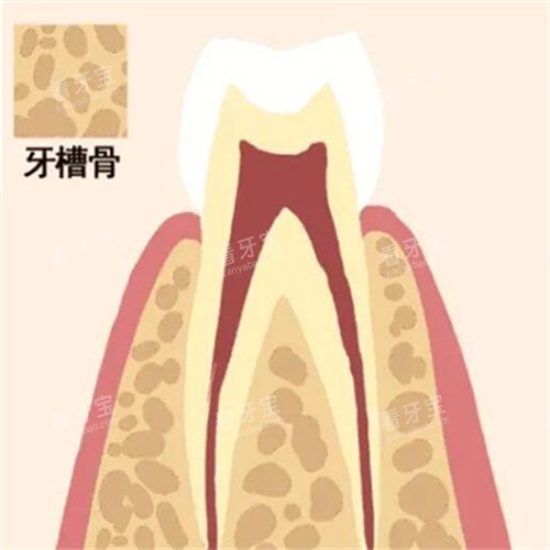 牙槽骨缺失卡通图 牙槽骨缺失卡通图