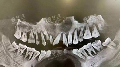 牙槽骨缺失照片图 牙槽骨缺失照片图