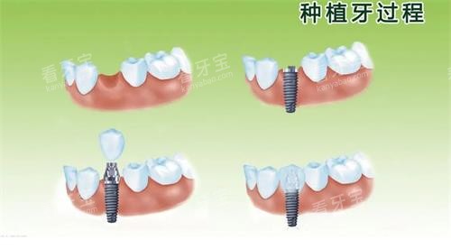 种植牙的过程 种植牙的过程