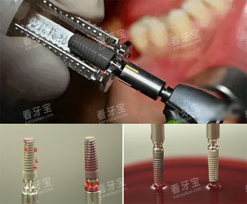 康盛种植牙照片 康盛种植牙照片