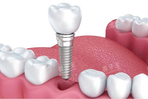 种植牙植入图 种植牙植入图
