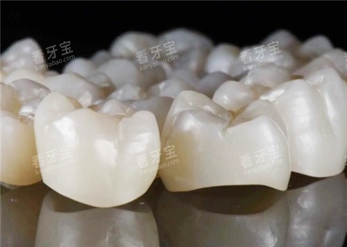 威兰德全瓷牙图示 威兰德全瓷牙图示