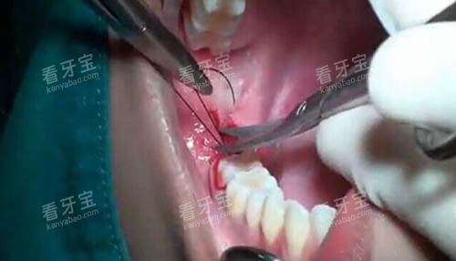 拔智齿手术细节图 拔智齿手术细节图