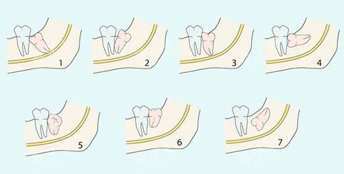 阻生智齿的不同类型 阻生智齿的不同类型