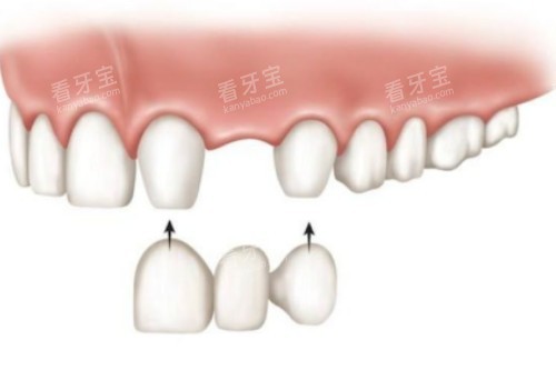 镶牙安装卡通图 镶牙安装卡通图