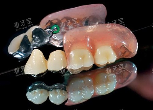 无挂钩假牙半口展示图 无挂钩假牙半口展示图