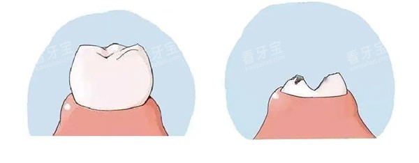 正常牙齿和坏牙对比 正常牙齿和坏牙对比