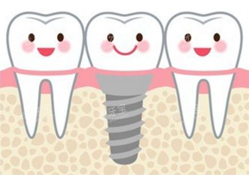 种植牙后动画展示图 种植牙后动画展示图