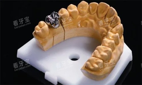 种植牙纯钛一体冠 种植牙纯钛一体冠