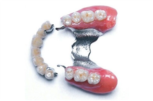 精密附着体和活动义齿成品 精密附着体和活动义齿成品