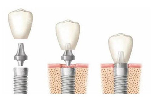 种植牙过程示意图13 种植牙过程示意图13