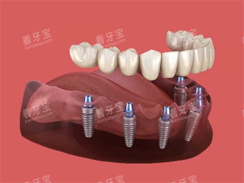 半口种植牙动画示意图展示 半口种植牙动画示意图展示