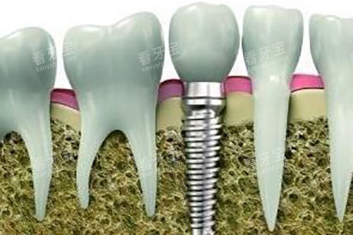 种植牙和真牙牙根对比示意图 种植牙和真牙牙根对比示意图