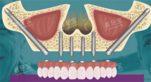 种植牙素材 种植牙素材