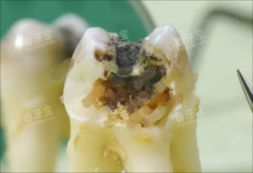 烂牙齿图片展示 烂牙齿图片展示