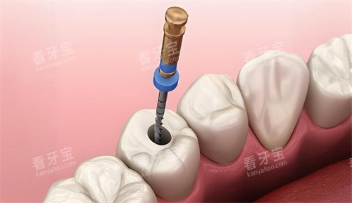 根管治疗过程展示 根管治疗过程展示