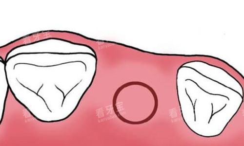 根管治疗切口 根管治疗切口