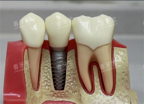 种植牙模型实物展示图 种植牙模型实物展示图