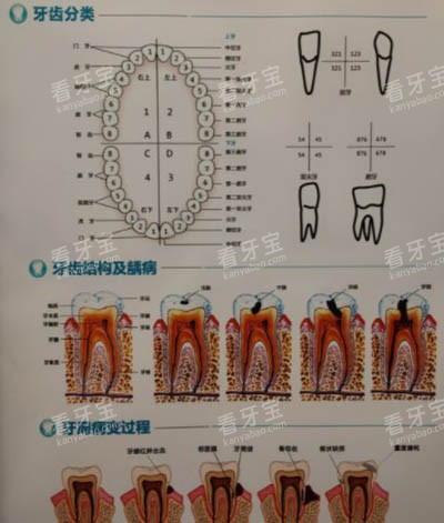 牙齿龋坏发展过程图 牙齿龋坏发展过程图