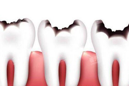 牙齿龋坏不同程度卡通示意图 牙齿龋坏不同程度卡通示意图