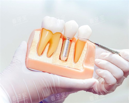 单颗种植牙模型 单颗种植牙模型
