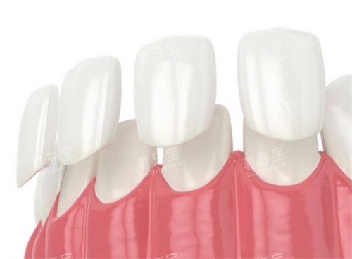 牙齿贴面动画展示图 牙齿贴面动画展示图