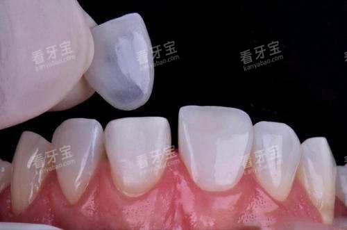 牙齿贴面过程 牙齿贴面过程