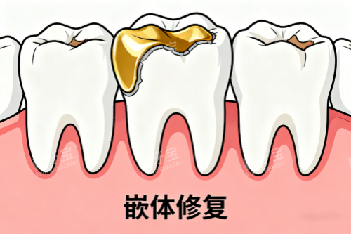 牙齿嵌体修复卡通图 牙齿嵌体修复卡通图