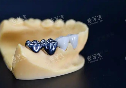 纯钛一体冠牙齿 纯钛一体冠牙齿