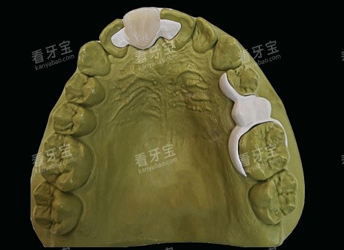 hpp粘接桥牙齿口腔内示意图 hpp粘接桥牙齿口腔内示意图