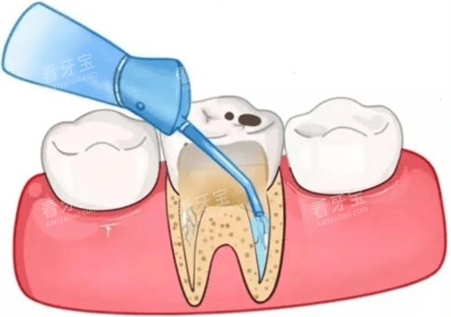 根管治疗图 根管治疗图