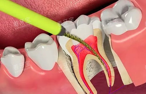 根管治疗过程模型展示图 根管治疗过程模型展示图