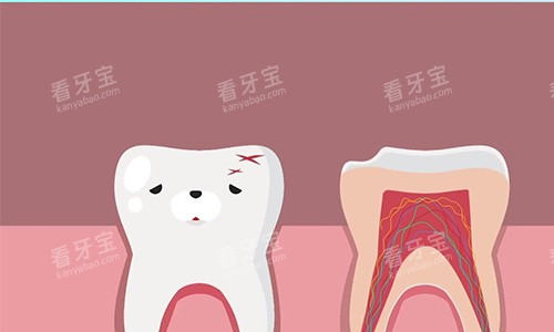 根管治疗的流程示意图 根管治疗的流程示意图