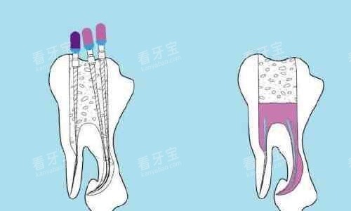 根管治疗手术示意图 根管治疗手术示意图
