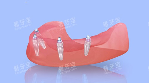 半口种植牙四颗植体植入漫画图 半口种植牙四颗植体植入漫画图