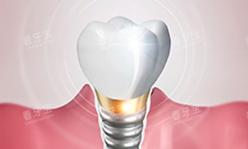 种植牙动画图 种植牙动画图