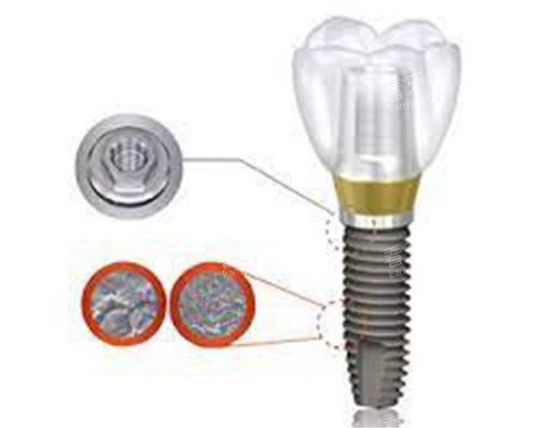 植是道种植牙 植是道种植牙