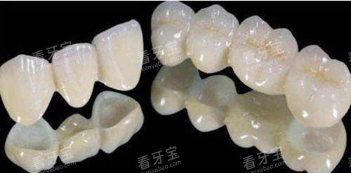 全瓷牙套照片 全瓷牙套照片