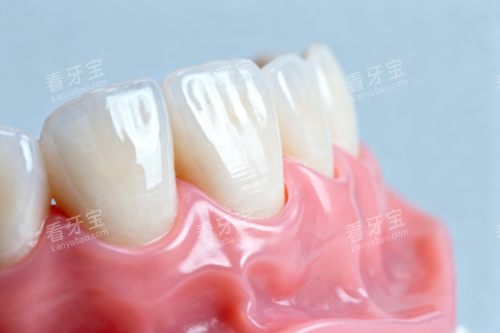 全瓷牙模型图 全瓷牙模型图