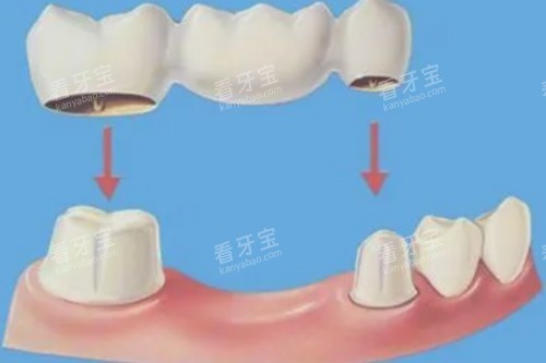 镶牙模型图 镶牙模型图