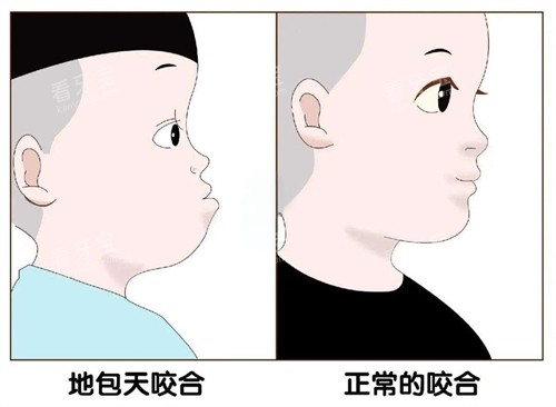 地包天和正常对比图 地包天和正常对比图